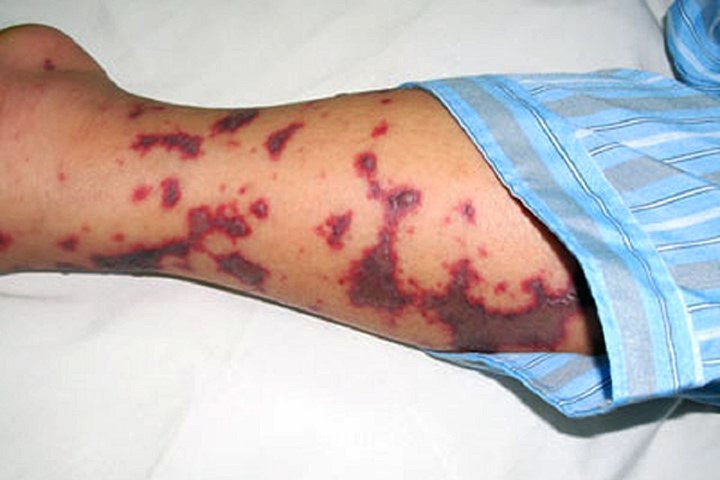 Một số bệnh lý nhiễm trùng có thể gây biến chứng và suy thận. Thí dụ viêm cầu thận sau nhiễm khuẩn liên cầu, nhiễm khuẩn nặng do các vi khuẩn có độc lực cao có thể gây sốc nhiễm khuẩn và suy thận cấp.