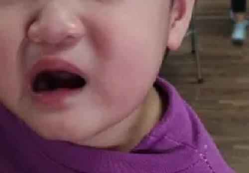 Bé 2 tuổi méo miệng, liệt dây thần kinh số 7 do trời rét đậm Be 2 tuoi meo mieng, liet day than kinh so 7 do troi ret dam