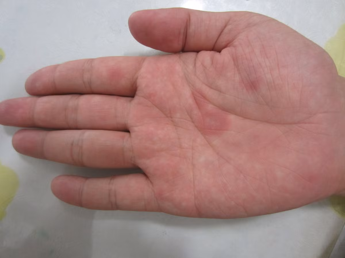 Ban tay co dac diem nay chinh la canh bao benh nguy hiem