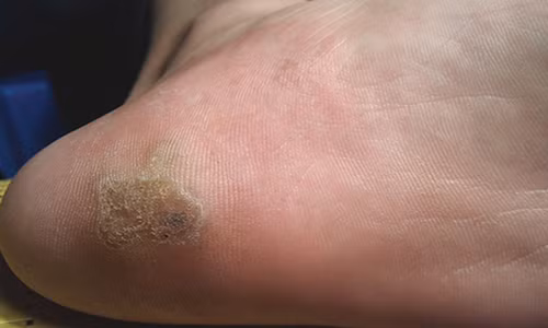 Lam gi khi bi chai chan tay tai phat?