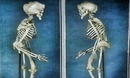 Bộ xương của "người voi" Merrick được đặt ở phòng trưng bày trong bảo tàng bệnh viện London trong suốt nhiều năm trước khi được thay thế bằng một bản sao. Thời gian qua, một số nhà khoa học nỗ lực nghiên cứu nhằm giải mã căn bệnh mà ông Merrick mắc phải.