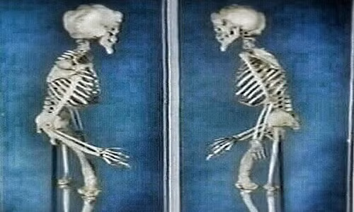 Bộ xương của "người voi" Merrick được đặt ở phòng trưng bày trong bảo tàng bệnh viện London trong suốt nhiều năm trước khi được thay thế bằng một bản sao. Thời gian qua, một số nhà khoa học nỗ lực nghiên cứu nhằm giải mã căn bệnh mà ông Merrick mắc phải.