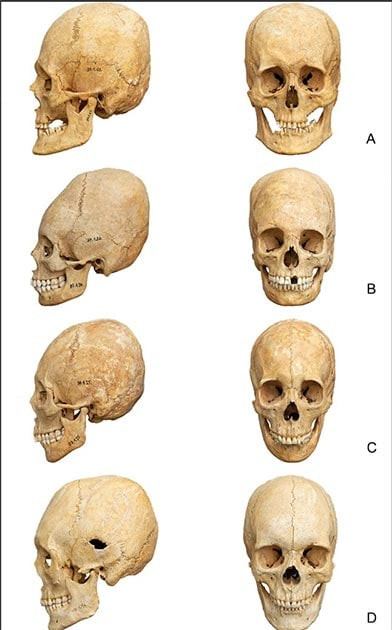 Khi khoảng 3 - 5 tuổi, hình dáng phần đầu của những đứa trẻ sẽ cố định vĩnh viễn. Lúc này, chúng sẽ có hộp sọ kéo dài như mong muốn.