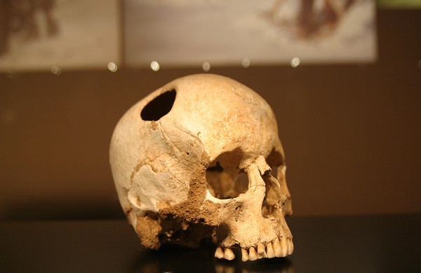 Do phương pháp khoan lỗ vào hộp sọ khá nguy hiểm nên không ít bệnh nhân tử vong ngay trong quá trình phẫu thuật hoặc trong quá trình bình phục.