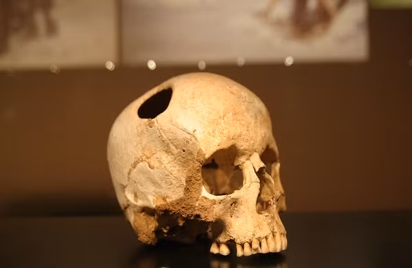 Do phương pháp khoan lỗ vào hộp sọ khá nguy hiểm nên không ít bệnh nhân tử vong ngay trong quá trình phẫu thuật hoặc trong quá trình bình phục.