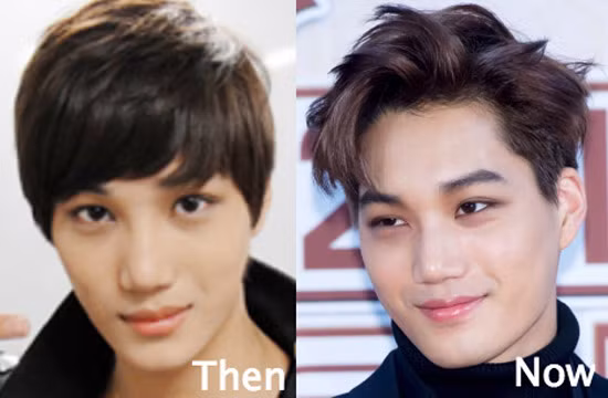 Hậu quả của việc cắt sửa mí quá nhiều mà mắt phải của Kai bị bé hơn mắt trái.