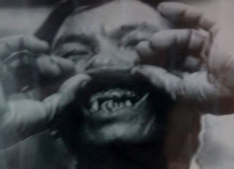 Một tù bình bị đục hết răng.