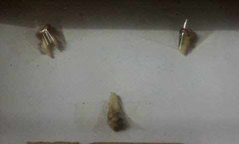 Những chiếc răng bị đục.