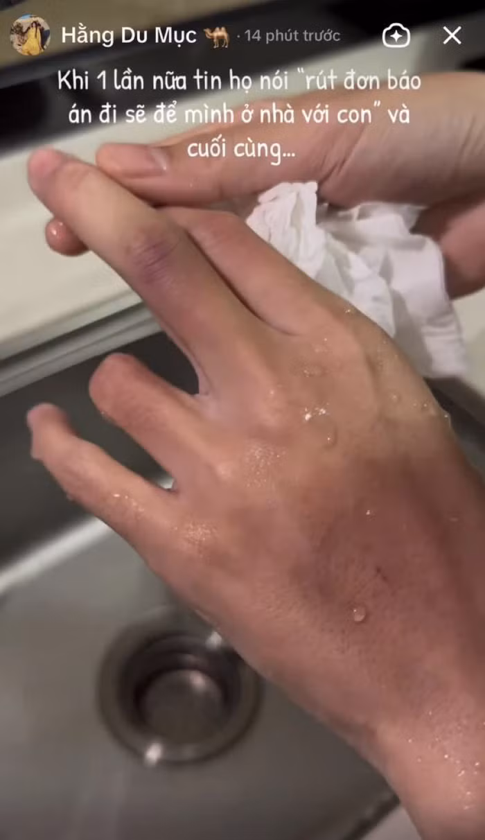 Hang Du Muc tieu tuy, xuong sac thay ro sau khi bi chong bao hanh-Hinh-2