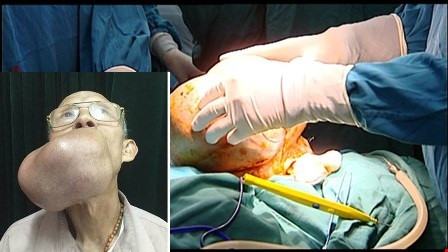 Phẫu thuật thành công khối u khổng lồ trên mặt cụ ông ảnh 1