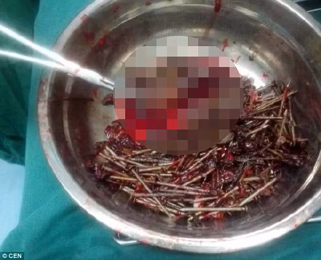 Mo lay 200 cai dinh, di vat la trong bung be trai-Hinh-2