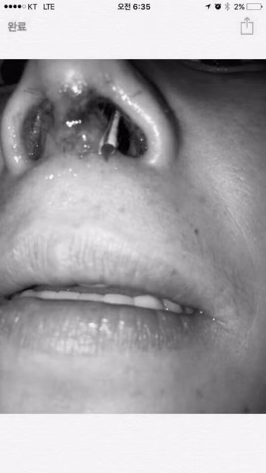 Nhưng chỉ cần xem ảnh là cũng có thể nhận ra đây là một tai nạn hoặc một biến chứng phẫu thuật mũi.