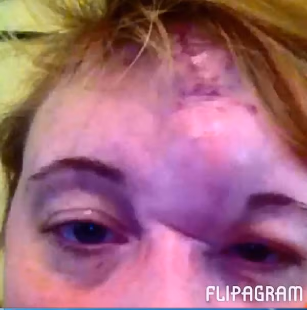 Một bà mẹ đã vô cùng sốc khi một vết bớt bẩm sinh trên mặt bỗng nhiên bung bét khi mang thai. Sam Davies đã sống với vết bớt này cả đời và còn được đặt biệt danh là “kỳ lân”. Nhưng khi mang thai vết này vỡ ra và bà mẹ 31 tuổi này phát hiện 3 khối u bên dưới. Bác sĩ đã phẫu thuật để cứu tính mạng và kết quả để lại là phần sọ bên trái gần như bị hở ra. Sam sau đó tuyên bố sẽ không sinh con nữa phòng khi “con quỷ lại thức dậy”.