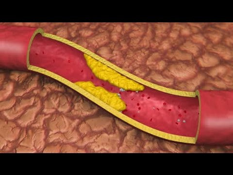 Khi chất béo bị tích tụ trong các động mạch – tức động mạch ngoại biên – máu không thể di chuyển tới các điểm đầu mũi gây lạnh tay. Bệnh này cũng có thể gây lạnh chân. Vì vậy nếu thấy liên tục bị đau chân sau khi vận động nhiều thì cần đi khám vì bệnh động mạch ngoại biên nếu không chữa thì có thể biến chứng thành bệnh tim mạch gây nguy hiểm đến tính mạng. 