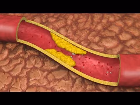 Khi chất béo bị tích tụ trong các động mạch – tức động mạch ngoại biên – máu không thể di chuyển tới các điểm đầu mũi gây lạnh tay. Bệnh này cũng có thể gây lạnh chân. Vì vậy nếu thấy liên tục bị đau chân sau khi vận động nhiều thì cần đi khám vì bệnh động mạch ngoại biên nếu không chữa thì có thể biến chứng thành bệnh tim mạch gây nguy hiểm đến tính mạng. 
