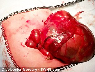 Khối u quái ác nặng khoảng 400g này đang phá hoại những cơ quan quan trọng nên bác sĩ cho rằng cần phải phẫu thuật càng sớm càng tốt sau khi em bé chào đời. 