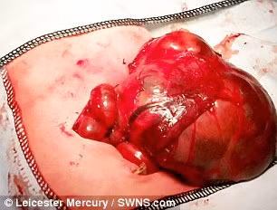 Khối u quái ác nặng khoảng 400g này đang phá hoại những cơ quan quan trọng nên bác sĩ cho rằng cần phải phẫu thuật càng sớm càng tốt sau khi em bé chào đời. 