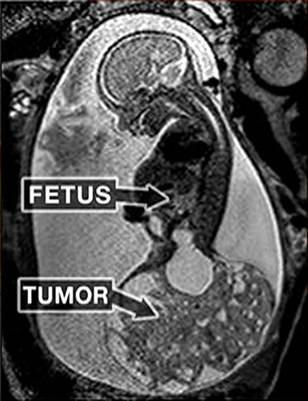 Một trường hợp được sinh ra hai lần khác là bé Macie Hope. Lần “chào đời” đầu tiên là khi bé Macie mới được 6 tháng trong bụng mẹ lúc này mới nặng hơn 100g. Khi siêu âm bác sĩ phát hiện ra một khối u ở phần xương cụt to không kém thì thai nhi và cũng chứa đầy các mạch máu. Tuy không phải là ung thư nhưng cũng có thể ảnh hưởng đến tính mạng của thai nhi nếu không được cắt bỏ kịp thời. (Ảnh: Today) 