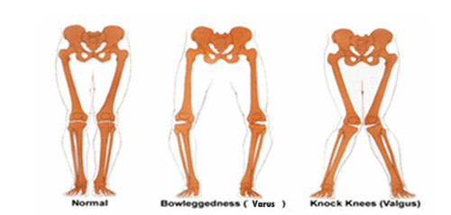 Kể cả khi không bị vòng kiềng, khi bé bước đi hai chân vẫn có thể cong. Lý do là vì khi tập đi, bé rất thận trọng với những bước chân của mình. Hơn nữa, trẻ cần giữ thăng bằng nên hay cong đầu gối lại để đỡ phần thân trên. Ở điểm này, cha mẹ không nên lo lắng. Điều này là hoàn toàn bình thường. 