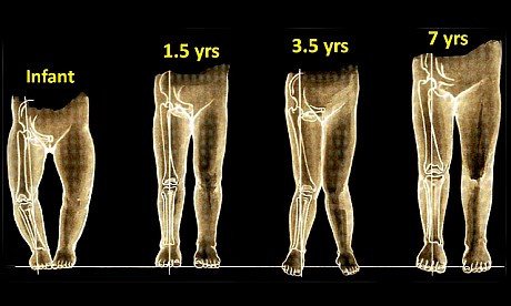 Thường thì hiện tượng chân vòng kiềng sẽ biến mất khi trẻ 3 tuổi. Trước đó nếu nghi ngờ hoặc sau thời điểm này chân bé vẫn vòng kiềng, cha mẹ hãy đưa bé đ khám bác sĩ. Thà thừa còn hơn phải hối tiếc về sau này. 