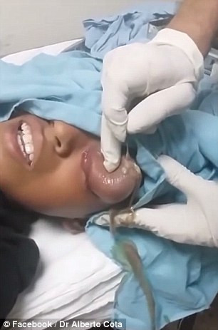 Thường thì những khối u vì chắp mắt như thế này sẽ tự khỏi và nếu không thì chỉ còn cách là phải rạch một đường để nặn ra. Trong trường hợp này bác sĩ đã làm đúng như thế bằng cách lấy dao mổ rạch một đường dọc hướng lên trán và ngay lập tức, dịch mủ lẫu máu bên trong cục u chảy ra ngoài. Đương nhiên cậu bé không ngừng la hét vì đau. 