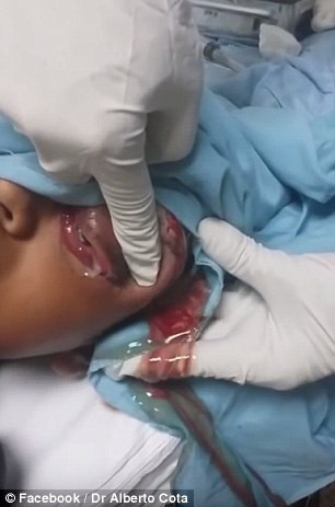 Sau khi được nặn chắp mắt, phần da mắt của cậu bé vẫn bị trùng nhưng sẽ lành và trở lại như cũ sau vài tuần. 