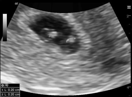 Đối với những trường hợp song thai cùng trứng tức cùng hợp tử thì chưa có bằng chứng nào cho thấy sinh trước 36 tuần là tốt. 