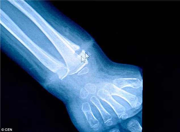 Nguyên nhân là do bố mẹ của Longlong làm việc ở thành phố Thành Đô nên phải gửi bé về quê để ông bà chăm sóc. Vì vậy mặc dù mới 4 tuổi nhưng cậu bé đã phải tự tắm và thay quần áo nên người nhà không phát hiện ra chiếc chun vòng dần ăn sâu vào cổ tay.