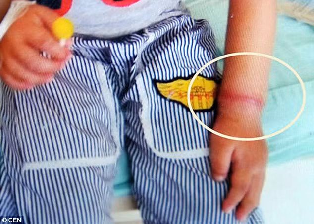 Em bé 4 tuổi tên Longlong người Trung Quốc suýt nữa đã phải cắt bỏ phần tay từ cổ tay trở xuống chỉ vì đeo chun vòng. Ban đầu Longlong được mẹ đeo vòng bằng bạc cho với ý nghĩa chiếc vòng đó sẽ bảo vệ bé. Tuy nhiên đến tháng 12/2015 bà của bé thấy chiếc vòng đã quá chật và tháo nó ra. Bà quan sát trên cổ tay cháu mình thấy có một vệt sưng màu đỏ xung quanh cổ tay và đã đưa bé đến bệnh viện để kiểm tra nhưng vệt đỏ kia vẫn không hết. 