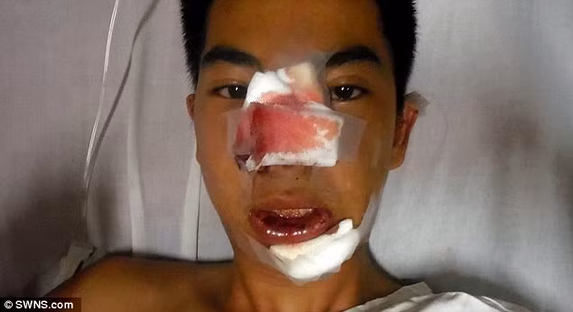 Bác sĩ phải từ từ phẫu thuật vài lần mới lấy được hết hỗn hợp kinh dị này ra khỏi mũi. Tuy hết viêm nhiễm nhưng mũi của anh chàng này hiện giờ trông nham nhở và chằng chịt sẹo. 