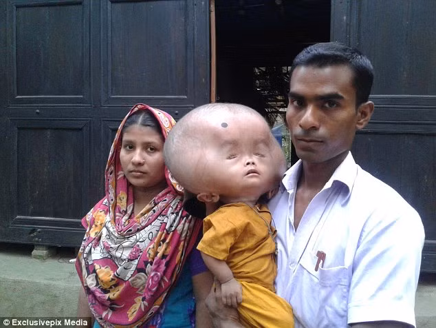 Vì kích thước đầu bé to và quá nặng nên dù đã đến tuổi biết đi nhưng Emon không biết nói, không biết đi thậm chí không cử động được chân tay – đồng nghĩa với việc bố mẹ bé phải liên tục chăm sóc bé.