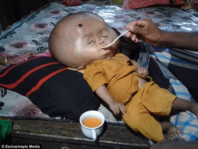 Emon được sinh bằng phương pháp mổ, lúc mới sinh phần đầu của bé chỉ to hơn kích thước trung bình một chút nhưng hai năm qua đầu bé không ngừng tăng kích thước.