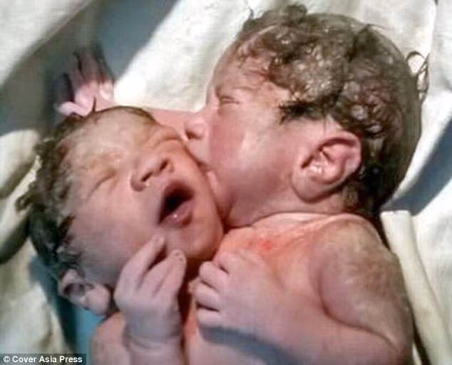 Cap sinh doi dinh lien nu hon khien cac bac sy bo tay