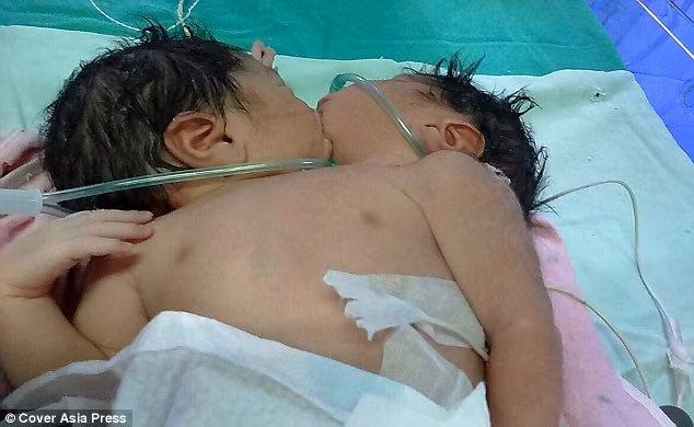 Cap sinh doi dinh lien nu hon khien cac bac sy bo tay-Hinh-2