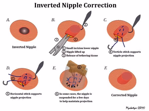 Điều đầu tiên cần làm là đi khám bác sĩ xem đây có phải là khiếm khuyết núi đôi bình thường không hay là dấu hiệu của một bệnh lý ở vú hoặc thậm chí là ung thư vú. Nếu bác sĩ kết luận không có gì đáng lo thì có thể phẫu thuật để chỉnh lại tùy thuộc vào cấp độ và chỉ cần dùng thuốc tê. Tuy nhiên, nếu đã phẫu thuật thì không thể cho con bú vì các ống sữa đã bị đứt. 