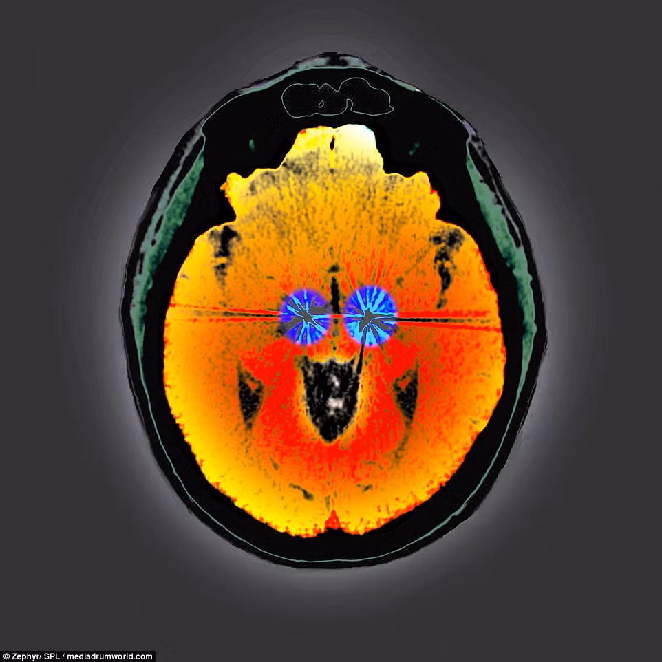 Đây là não của một bệnh nhân bị bệnh Parkinson. Hai cực điện của thiết bị kích thích não đã được cấy vào não để điều hòa nhịp tim. Thiết bị này gửi tín hiệu xung điện đến các vùng não màu xanh để cải thiện những triệu chứng của bệnh này.