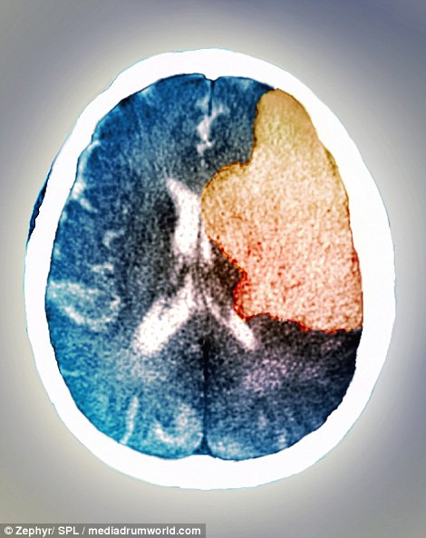 Đây là hình ảnh của não trong cơn đột quỵ. Ảnh chụp CT cho thấy vùng não bên phải của bệnh nhân đã bị liệt sau khi bị đột quỵ. Đột quỵ xảy ra khi lượng máu cung cấp cho một vùng não nào đó bị thiếu hoặc hoàn toàn không có khiến các tế bào não chết đi. 