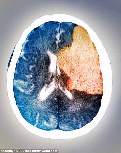 Đây là hình ảnh của não trong cơn đột quỵ. Ảnh chụp CT cho thấy vùng não bên phải của bệnh nhân đã bị liệt sau khi bị đột quỵ. Đột quỵ xảy ra khi lượng máu cung cấp cho một vùng não nào đó bị thiếu hoặc hoàn toàn không có khiến các tế bào não chết đi. 