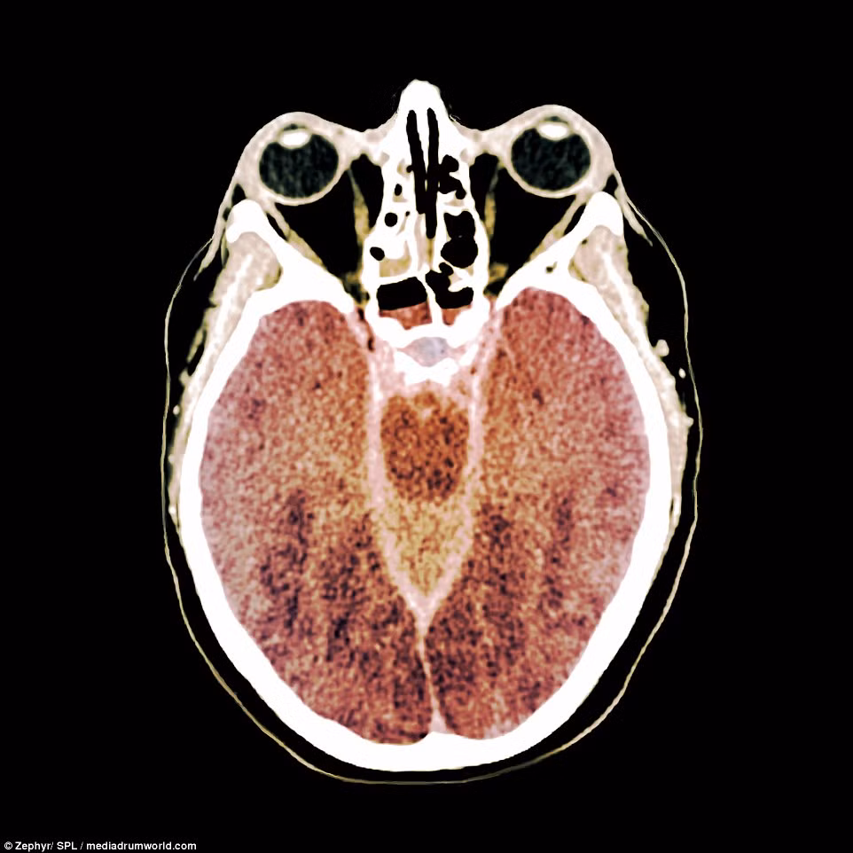 Đây là hình ảnh chụp CT của một bệnh nhân đang chỉ sống nhờ máy móc vì chết não, tức mất đi toàn bộ chức năng của cơ thể. Não chết do thiếu oxy, hay còn gọi là thiếu oxy huyết, mặc dù bệnh nhân đã được hồi sức sau tai nạn lặn. Ảnh cho thấy mật độ não bị giảm trên toàn bộ khối não, điều thường thấy ở những người bị thiếu oxy huyết. 