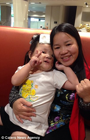 Cũng vì khối u trên mặt này mà bé Nguyệt không thể mọc được tóc và răng ở bên phía nửa trái. Sau khi gặp 6 bác sĩ khác nhau và không có đủ tiền để chi trả cho phẫu thuật, gia đình bé Nguyệt đã từ bỏ hy vọng có thể cứu chữa cho cô bé.