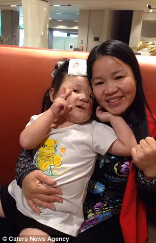 Cũng vì khối u trên mặt này mà bé Nguyệt không thể mọc được tóc và răng ở bên phía nửa trái. Sau khi gặp 6 bác sĩ khác nhau và không có đủ tiền để chi trả cho phẫu thuật, gia đình bé Nguyệt đã từ bỏ hy vọng có thể cứu chữa cho cô bé.