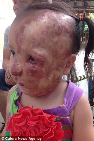 Trải qua hai lần phẫu thuật, lần thứ nhất là cắt bỏ khối u, lần thứ 2 là cấy dụng cụ làm giãn da dưới da đầu gương mặt và chất lượng cuộc sống của cô bé 5 tuổi may mắn đã được cải thiện đáng kể. Sau phẫu thuật, bé Nguyệt phải uống thuốc trong vòng 2 năm để khối u co lại và bà Maxey đã tình nguyện lấy tiền túi để mua số thuốc này.