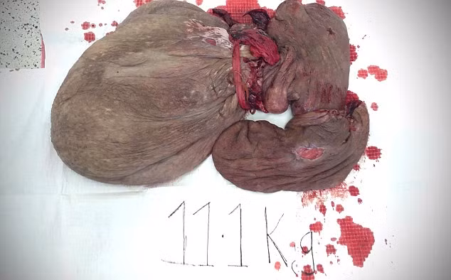 Khối u được cắt bỏ có trọng lượng tới 11,1kg.