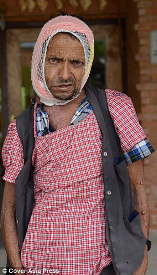 Ông Krishna hiện đang hồi phục sức khỏe mặc dù vẫn còn phải băng bó một bên mặt. Mặc dù những cục thịt thừa trên mặt vẫn còn nhưng có vẻ như việc cắt bỏ khối u khổng lồ kia không để lại biến chứng. (Nguồn ảnh: DM)