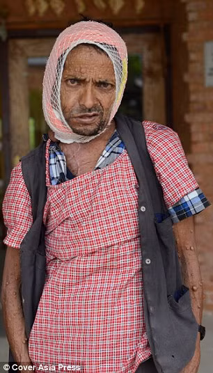 Ông Krishna hiện đang hồi phục sức khỏe mặc dù vẫn còn phải băng bó một bên mặt. Mặc dù những cục thịt thừa trên mặt vẫn còn nhưng có vẻ như việc cắt bỏ khối u khổng lồ kia không để lại biến chứng. (Nguồn ảnh: DM)