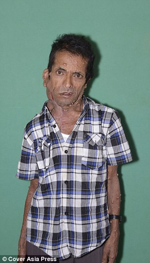 Ngoài những khối u chảy dài đến rốn thì ông Krishna còn mọc rất nhiều cục thịt thừa trên mặt và không có cách điều trị nào khác ngoài cắt bỏ nhưng ông lại không có tiền chi trả phẫu thuật. 