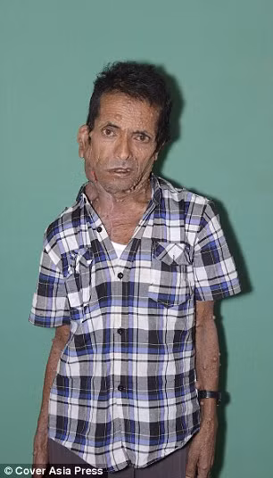 Ngoài những khối u chảy dài đến rốn thì ông Krishna còn mọc rất nhiều cục thịt thừa trên mặt và không có cách điều trị nào khác ngoài cắt bỏ nhưng ông lại không có tiền chi trả phẫu thuật. 