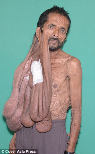 Một người đàn ông phải sống gần như cả đời với một khối u trên mặt cuối cùng cũng đã được phẫu thuật để cắt bỏ. 