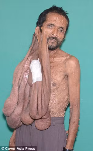 Một người đàn ông phải sống gần như cả đời với một khối u trên mặt cuối cùng cũng đã được phẫu thuật để cắt bỏ. 