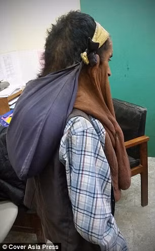 Ông Krishna Krishna Prasad Bhattarai người Nepal năm nay đã 60 tuổi mọc u trên mặt từ khi còn nhỏ. Trong suốt 47 năm khối u cứ thế tăng kích thước không ngừng khiến khuôn mặt ông bị biến dạng.